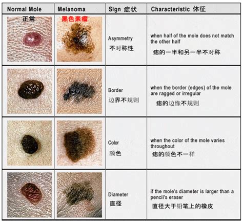 男生下面黑痣|痣也可能会癌变！长在 3 个地方要注意